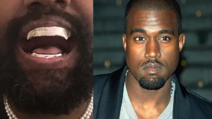 Kanye West replaces teeth with titanium gnashers