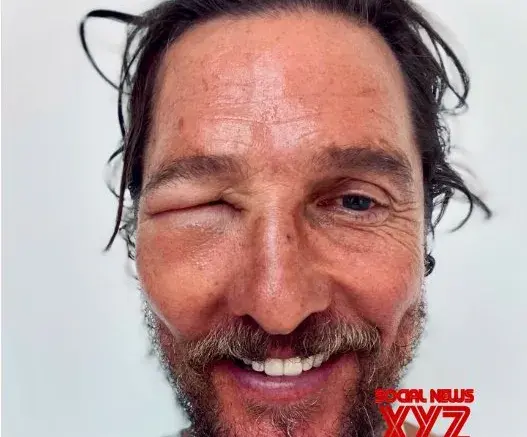 Matthew McConaughey gets a swollen eye from bee sting